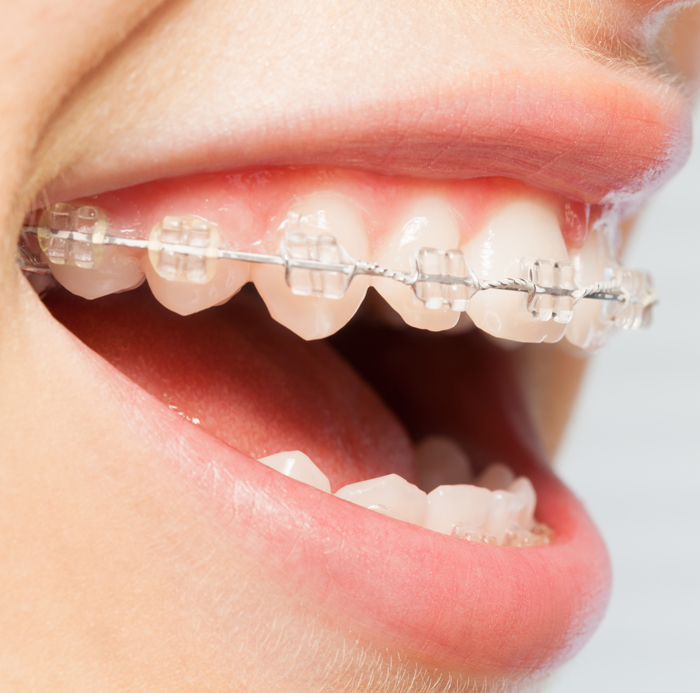 Orthodontics Correction Of Jaws With Clear Bracket