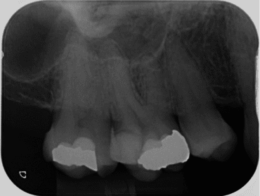 Root canal treatment near me
