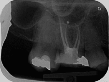 Root Canal Near Me