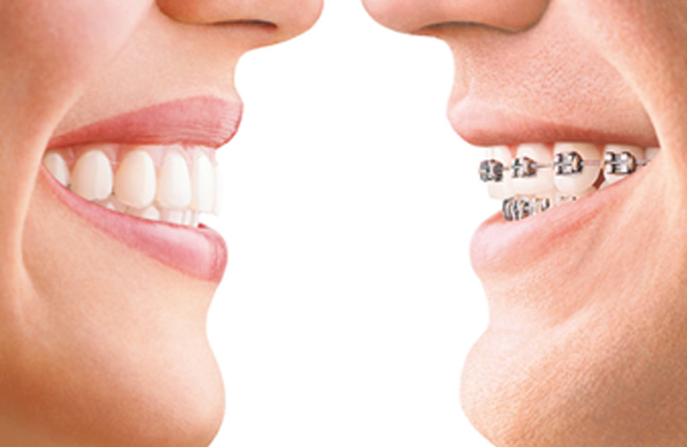 invisalign-v-braces