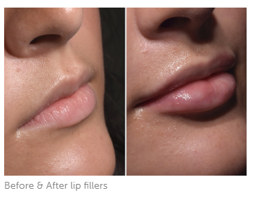 before and after lip fillers near me hertfordshire