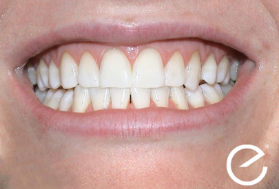 Englighten Teeth Whitening Results