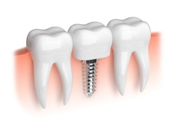 dental implant hemel hempstead