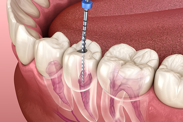 root canal treatment near me