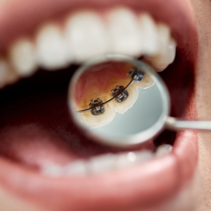 Private Orthodontist Hertfordshire Hemel Hempstead