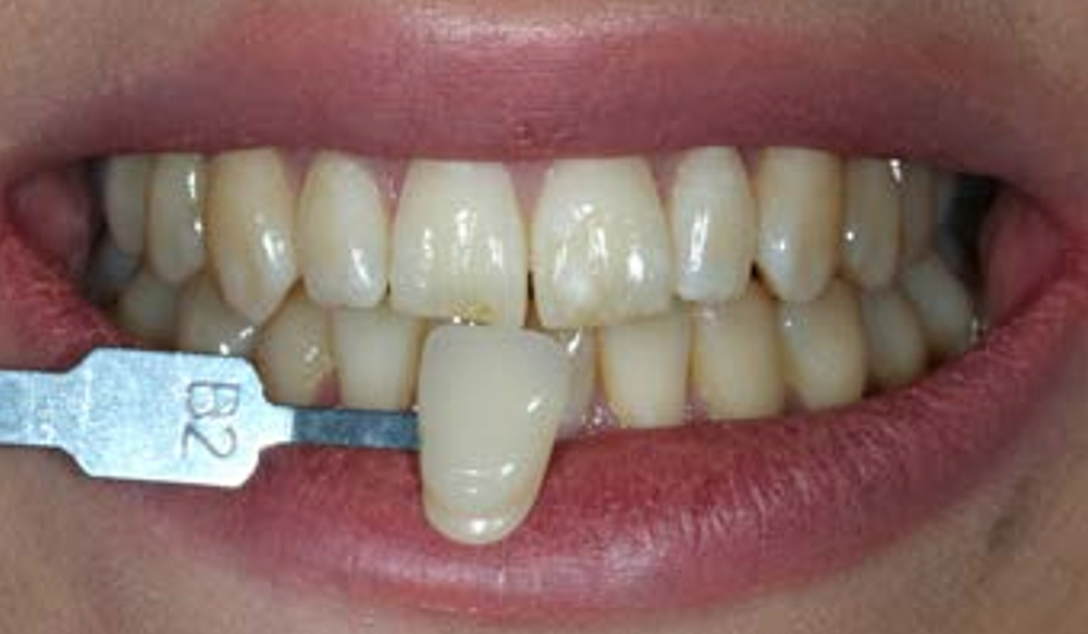 before and after teeth whitening near me hemel hempstead