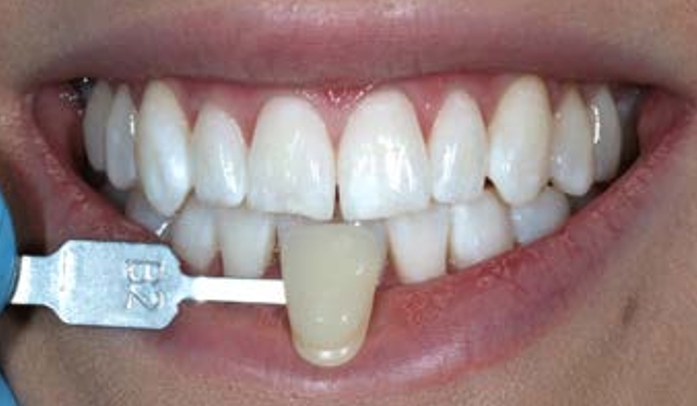 before and after teeth whitening near me hemel hempstead