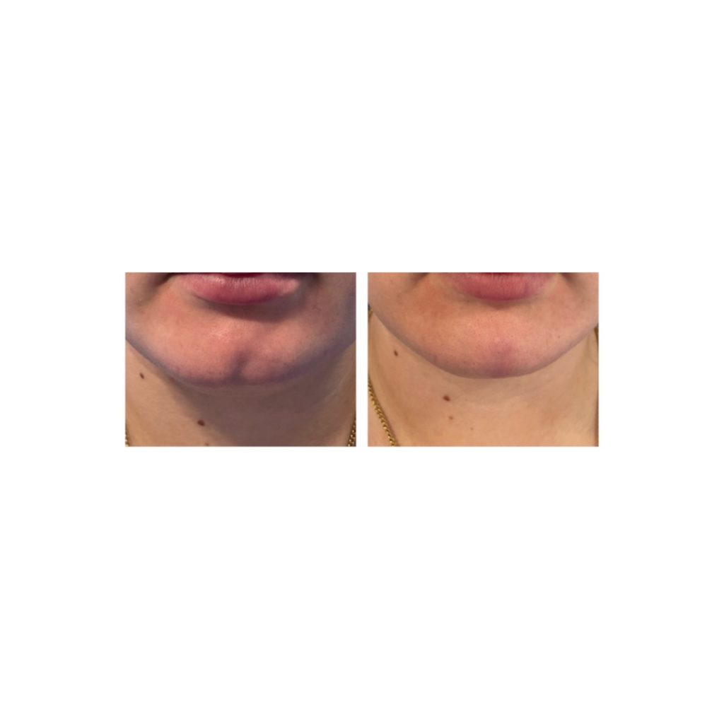 chin filler dermal fillers near me