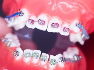 fixed braces near me