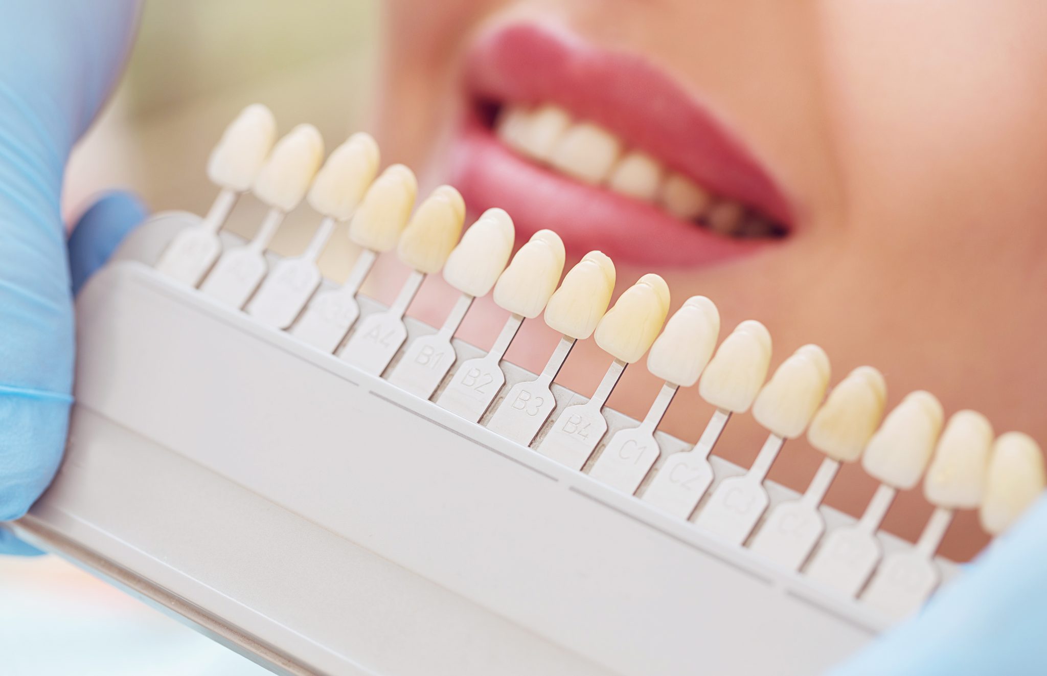 What is Teeth Whitening and How Does it Work? Landmark Dental