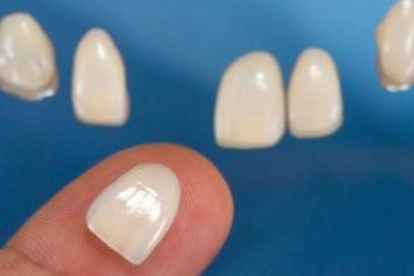 dental implants vs veneers