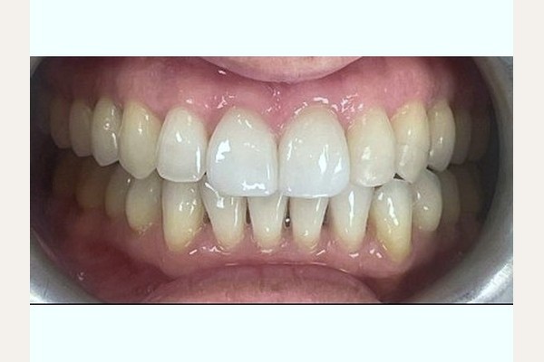 After treatment, front view showing straight teeth