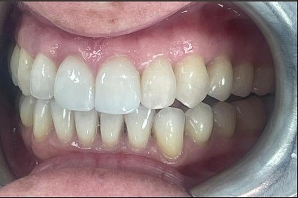after-02-right-buccal-tile