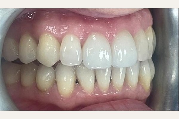 After treatment, left side view showing the corrected bite