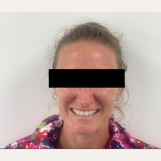 After: the smile proportioned to her face