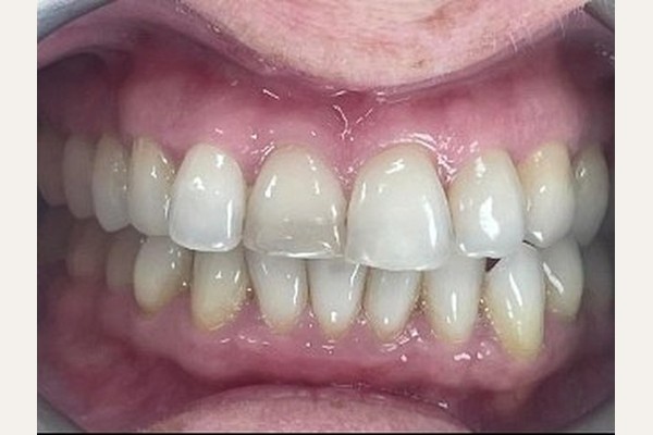 Before treatment, front view of the teeth