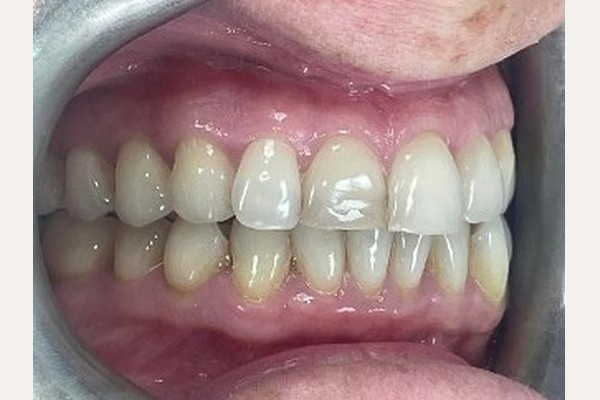 Before treatment, right side view of the bite