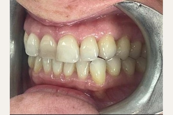 Before treatment, left side view of the bite