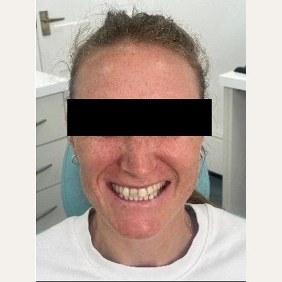 Before: how the smile presented