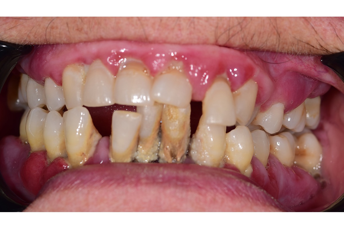 Before treatment: loose, drifting teeth with advanced gum disease