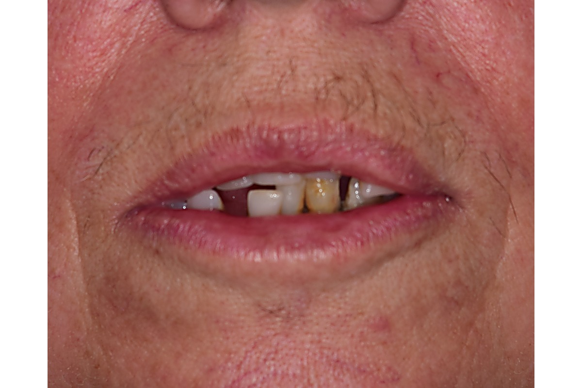 Before: loose, drifting teeth and advanced gum disease