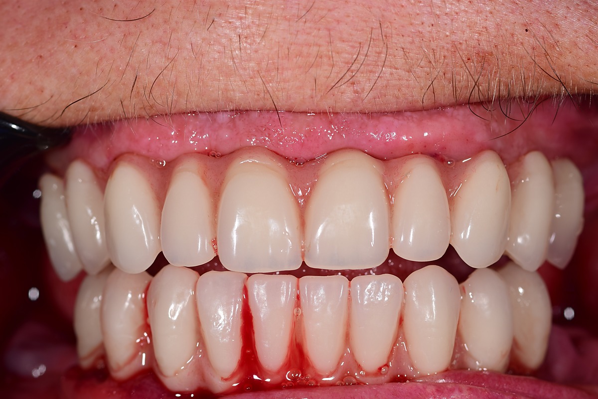 Immediately after surgery showing the fixed provisional teeth in place
