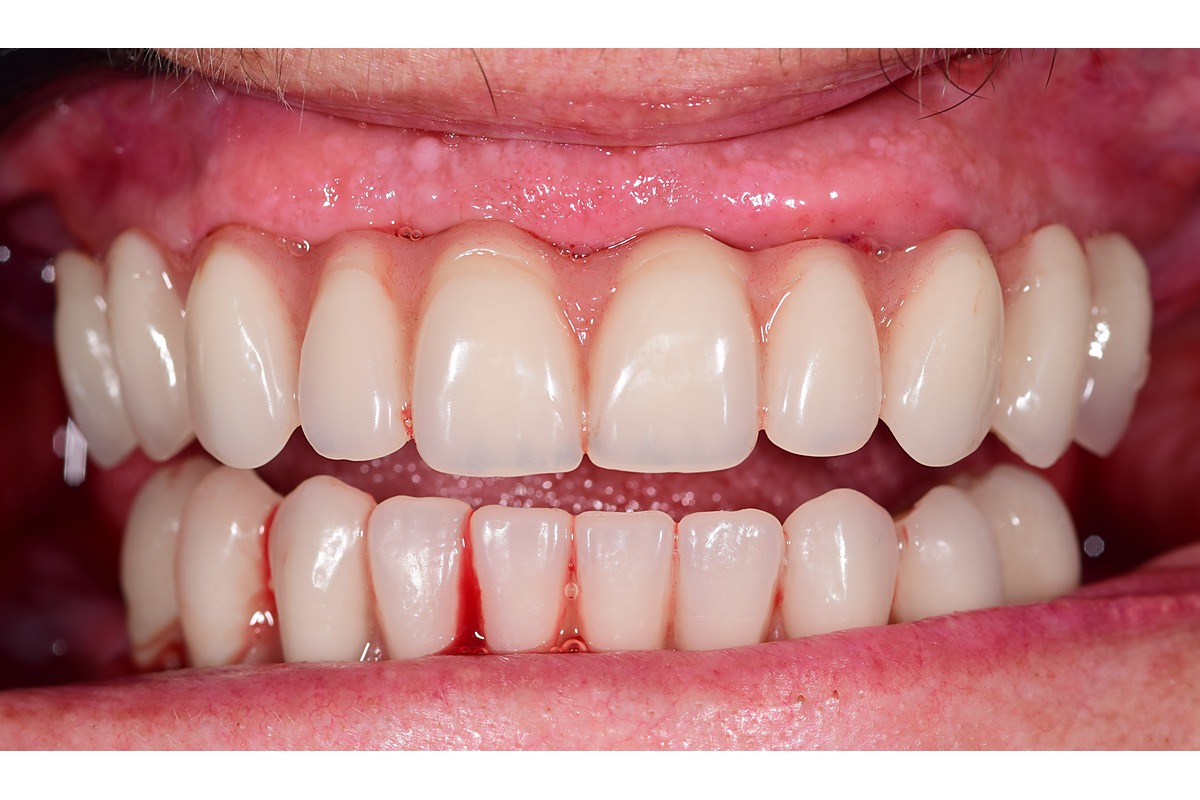 Treatment day: failing teeth removed, implants placed and fixed provisional bridges fitted