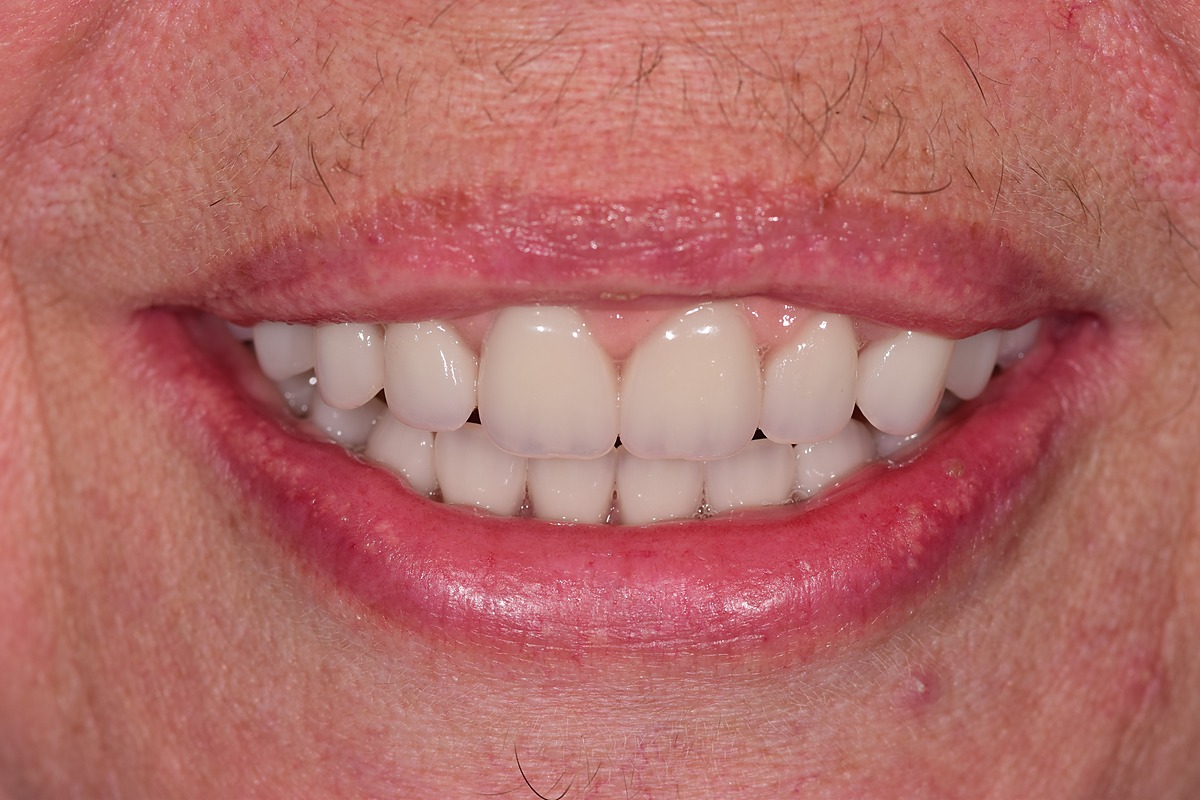 Final result: the definitive bridges have been fitted