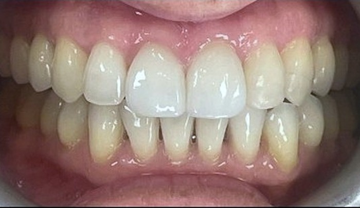 After: straight teeth with even edges