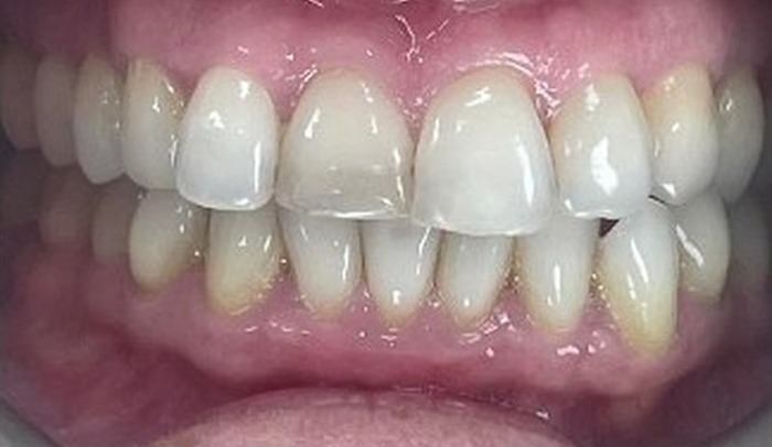 Before: crowded teeth with uneven edges