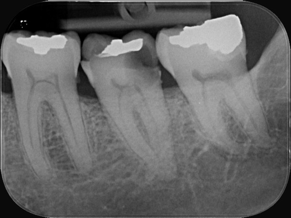 Radiograph before treatment showing extensive decay and breakdown of a lower back tooth