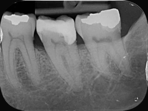 Pre-endodontic composite build-up