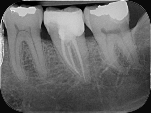 Radiograph following root canal treatment