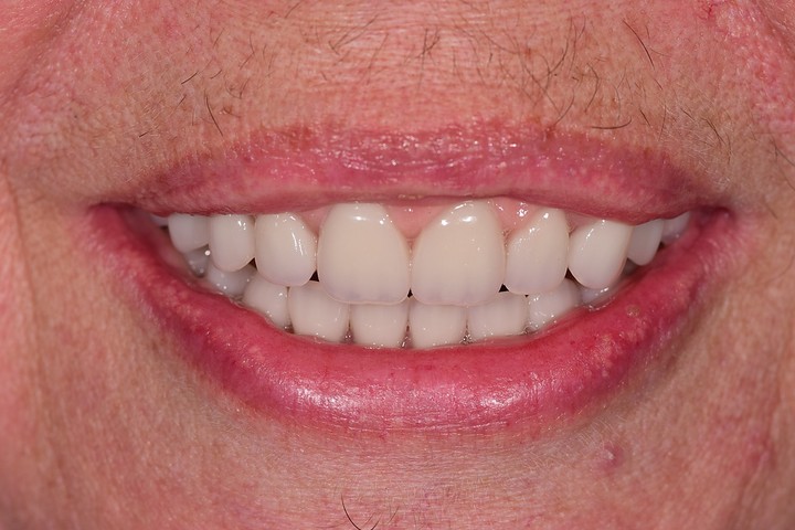 thumb-full-mouth