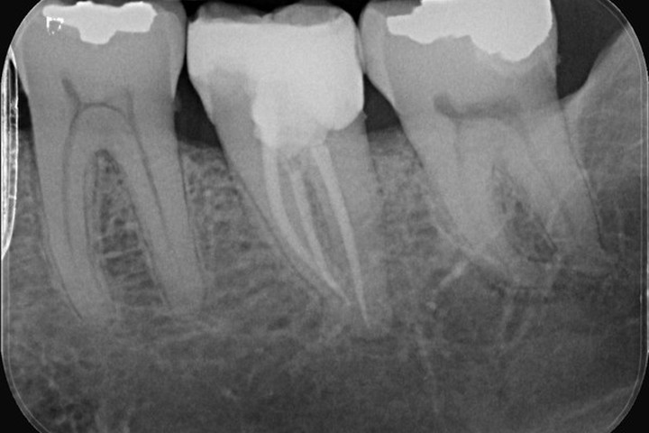 thumb-root-canal